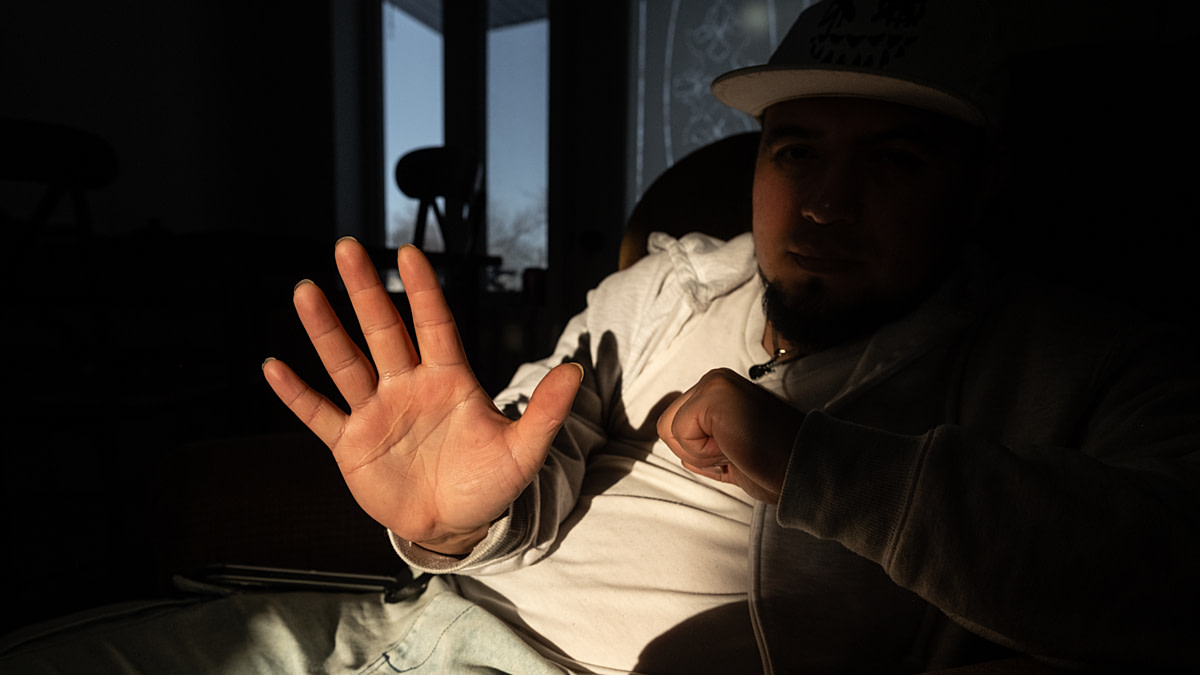 Rudy Samayoa, a former slaughterhouse worker, shows the scars from his hand surgery. Both of Samayoa's hands were injured by the repetitive task of removing fat from cuts of meat.  Undisclosed location, Sainte-Hyacinthe, Quebec, Canada, 2025. Ira Moon / We Animals